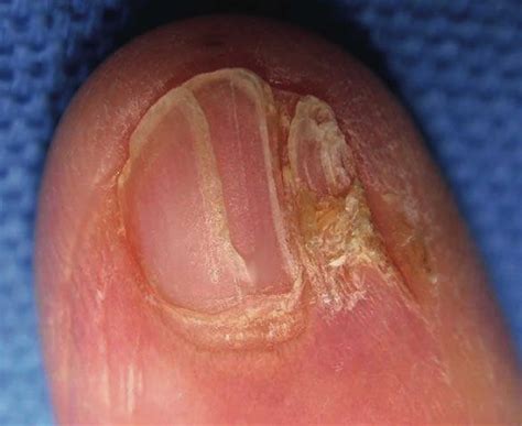 Nail dystrophy definition, causes & treatment