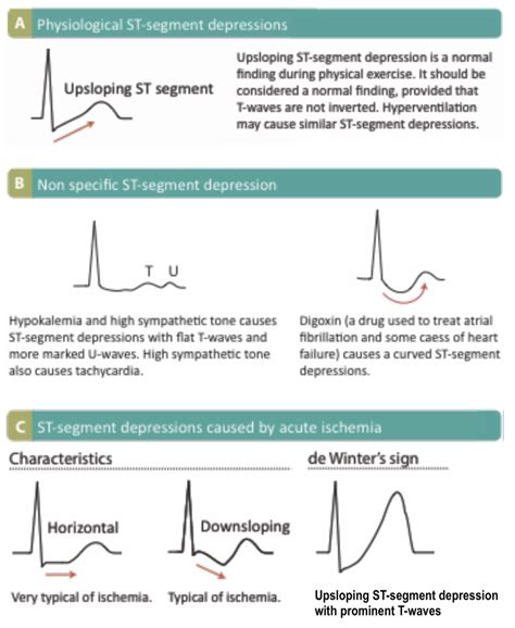 ST Segment and T Wave Abnormalities | EMcyclopedia