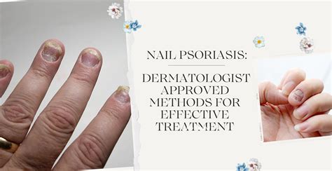 Onycholysis Psoriasis Onycholysis Nail: Causes & Prevention
