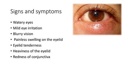 CHALAZION.pptx