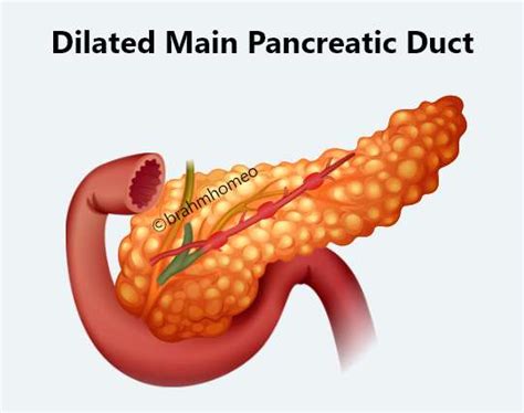 Peripancreatic Fat Stranding | Peripancreatic Fat Stranding Treatment