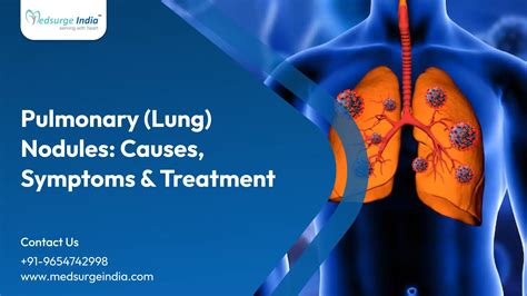 Pulmonary (Lung) Nodules: Causes, Symptoms & Treatment