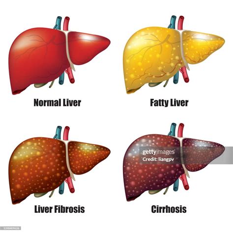 Stages Of Liver Disease High-Res Vector Graphic - Getty Images