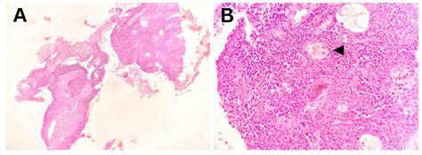 Clinical Characteristics, Diagnosis, and Management of Primary ...