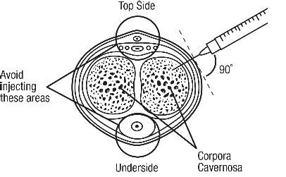 Caverject Impulse Tutorial 的图像结果