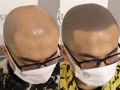 中老年脱发人士不用再留光头了，3D纹发技术黑科技来袭 - 知乎