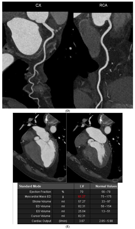 Discrepancies between Coronary Artery Calcium Score and Coronary Artery ...