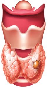 Bocio: alteraciones de la glándula tiroides | Cuida tu tiroides
