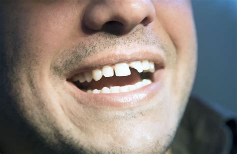 Treatment for Chipped Teeth - Windsor, CA