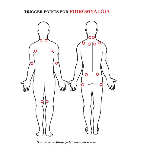 What Are The Pressure Points Of Fibromyalgia at Michael Sizemore blog
