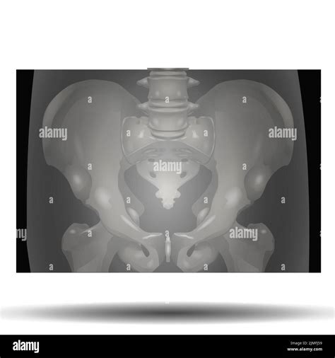 Pelvis Xray Anatomy