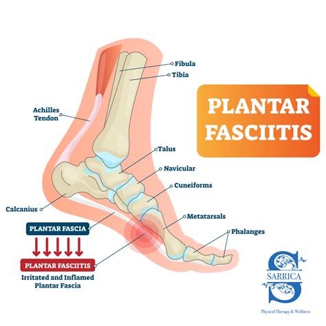 Plantar Fasciitis Symptoms, Treatments | How Physical Therapists Can Help — Sarrica