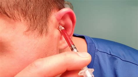 Kuvatulokset haulle cauliflower ear