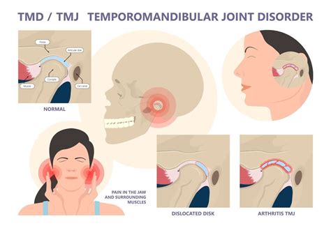 Temporomandibular Joint Dysfunction Headaches