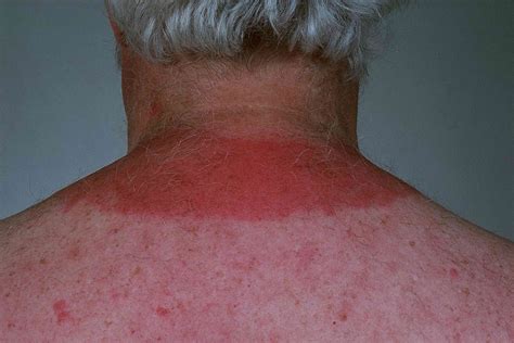 Intense Itching Sunburn