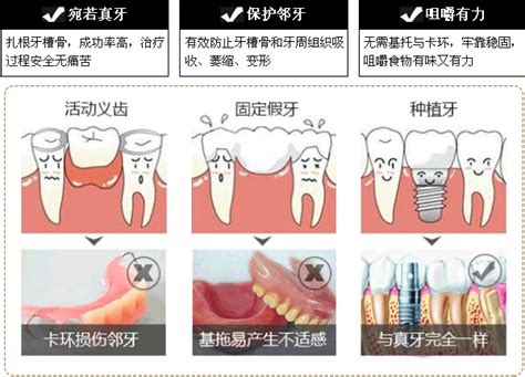 分段式全口种植牙做即刻负重怎么样?一般满口种植牙多少钱,种植牙-8682赴韩整形网