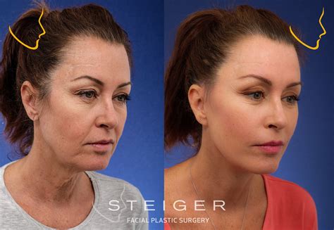 Ultra Laser Face Lift at Georgia Challis blog