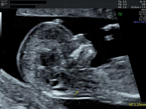 Ultrasound 的图像结果