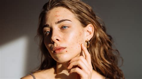 How to Remove Red Spots from Face: Best Natural Remedies