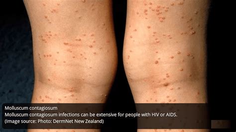 Std Skin Rash