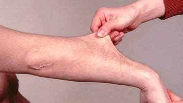 Pediatric Dermatology : Ehlers Danlos Syndrome : Ehlers Danlos Syndrome ...