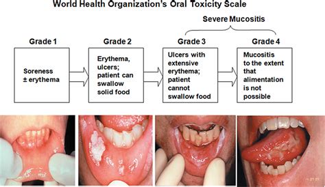 Oral mucositis definition, causes, symptoms, treatment guidelines ...