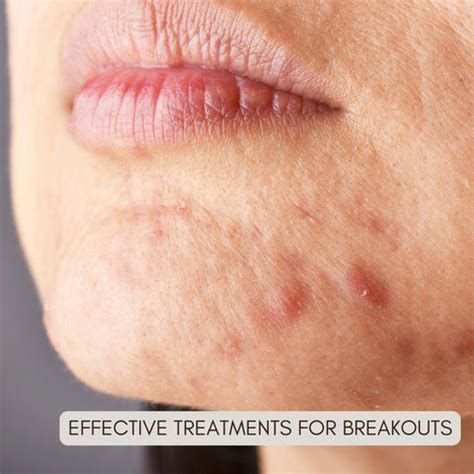 Purging vs. Breakouts: Identifying and Managing Skin’s Response ...