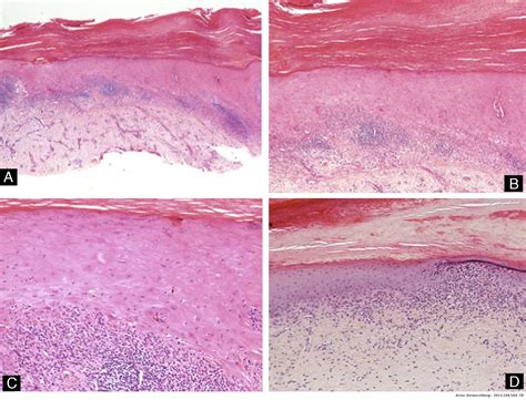 Torus Mandibularis Histology