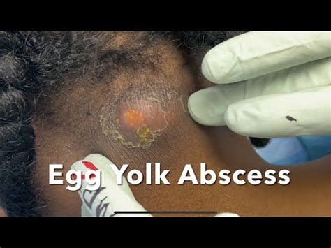 Image result for Painful Giant Abscess Exploding