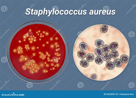 Staphylococcus Aureus Sinus Infection