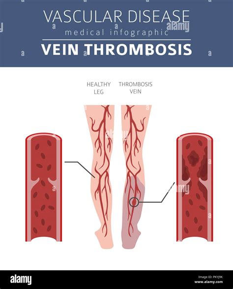 Vascular diseases. Vein thrombosis symptoms, treatment icon set. Medical infographic design ...