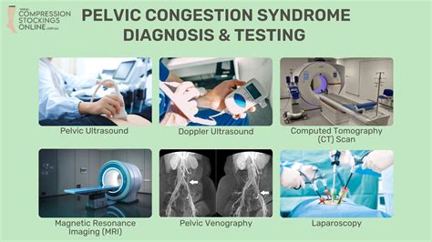 What is Pelvic Congestion Syndrome? Causes & Treatment – Compression ...