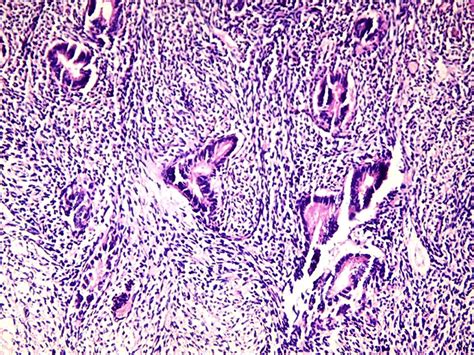 Image result for Disordered Proliferative Endometrium