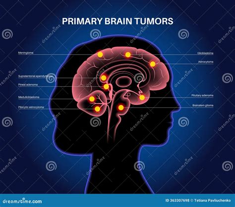 Primary brain tumors stock illustration. Illustration of vision - 363307698