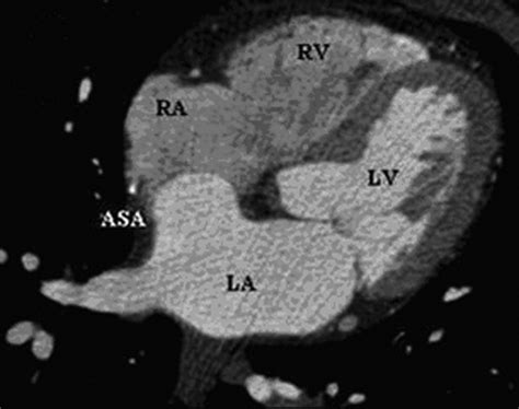 Detection of Atrial Septal Aneurysm by ECG-Gated MDCT | AJR