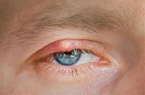 What is That Yellow Bump on My Eyelid? | Old South Optometry