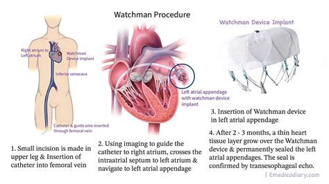 Image result for Video Watchman Device.com