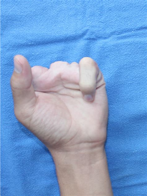 What is Hand Surgery? - EMC Hospital
