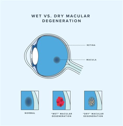 Wet Vs Dry Macular Degeneration Age Related Macular Degeneration (AMD)