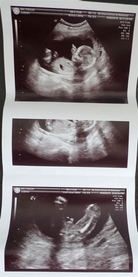 【大图】怀孕32周_双胞胎胎儿发育图_科普图库_太平洋亲子网