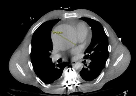 Aortic Root Dilation and Testosterone Use: Are They Associated ...