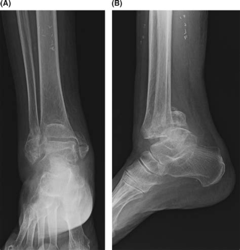 Anterioposterior radiograph demonstrating a severely co | Open-i