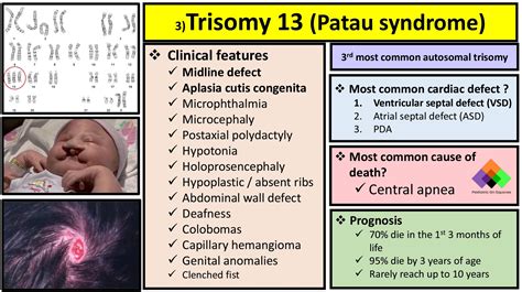 Trisomy 13 Life Expectancy