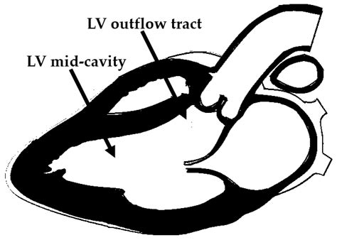 Diagnosis and Treatment of Obstructive Hypertrophic Cardiomyopathy