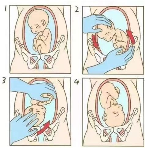 外倒转术，让臀位宝宝在妈妈肚子里“华丽转身”-工作动态-护理天地-太和县人民医院