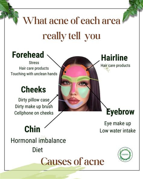 Cheek Acne Causes