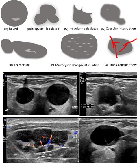 Sonographic localisation of neck lymph nodes using surgical neck level classifications - Fenech ...