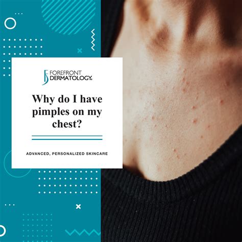 Why Do I Have Pimples on My Chest? - Forefront Dermatology