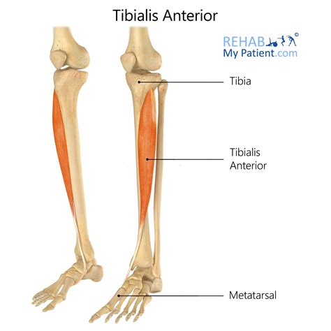 Tibialis Anterior Tendon Tear