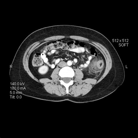 Ct Scan For Diverticulitis